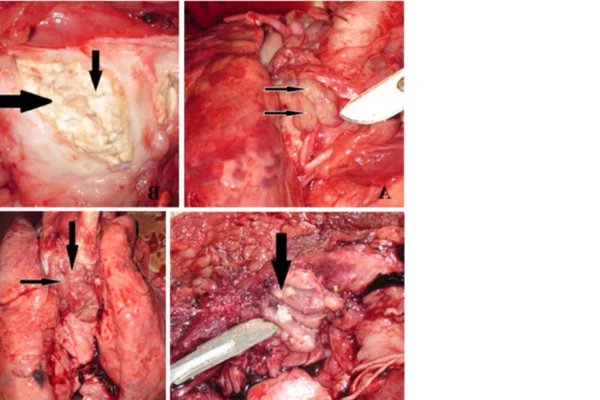 Tuberculose Suína