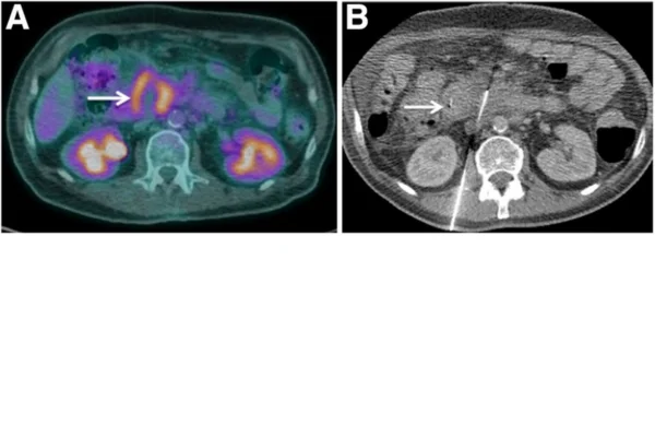 Carcinoma pancreático em Cães