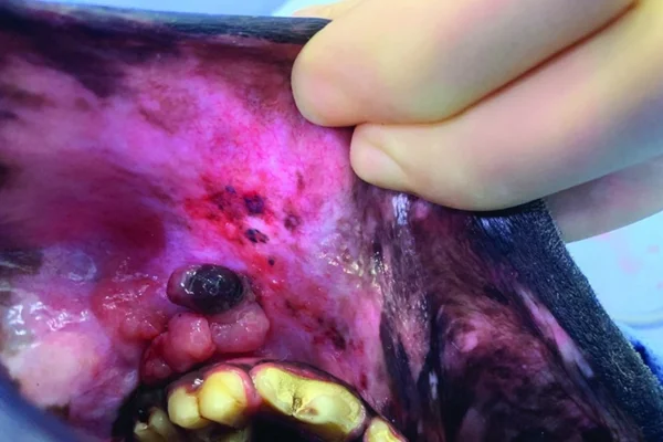 Melanoma oral